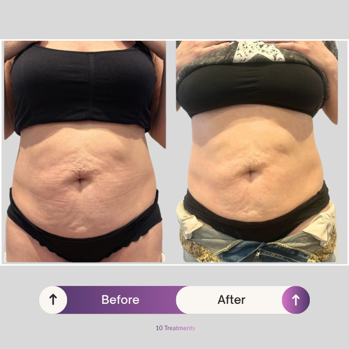 Before and after comparison of a person's stomach with text indicating 10 treatments.