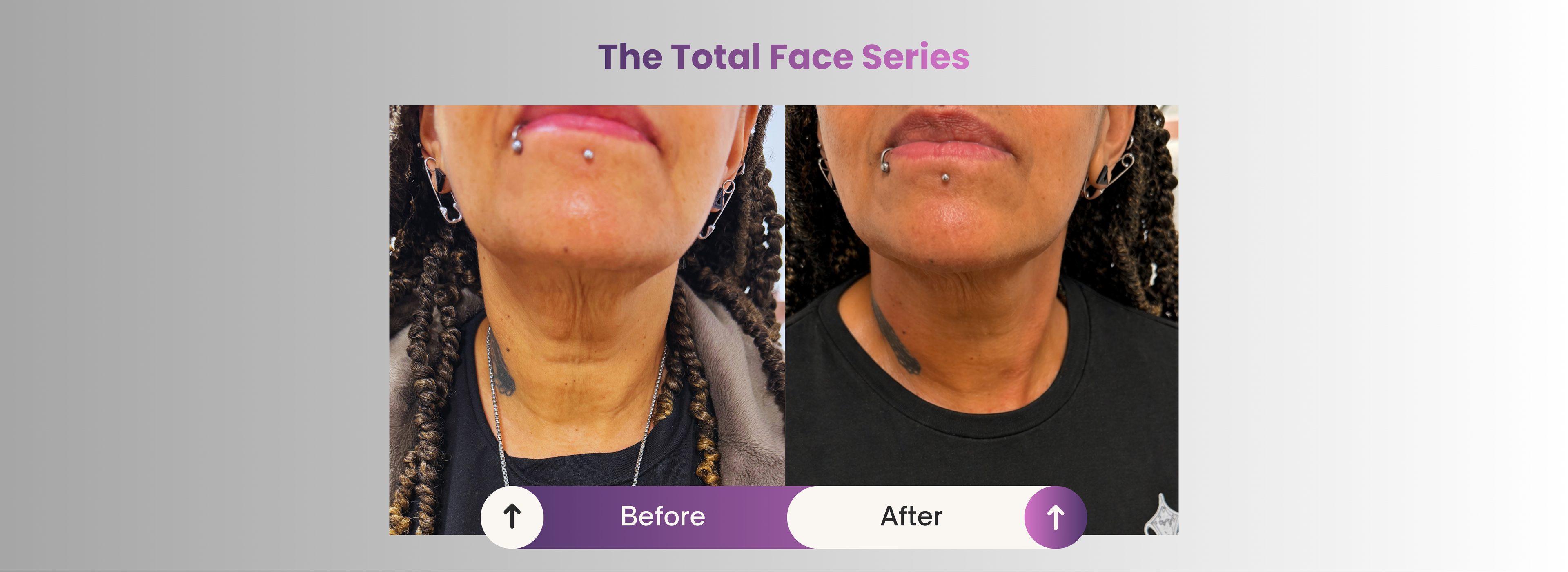 Before and after comparison of a neck treatment with visible results.