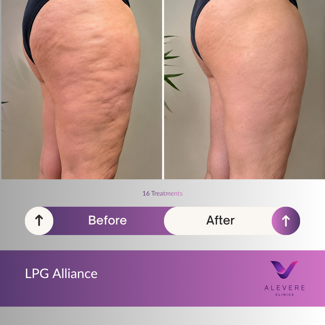 Before and after comparison of a person's leg with visible skin texture improvement, branded with LPG Alliance and Alevere Clinics.