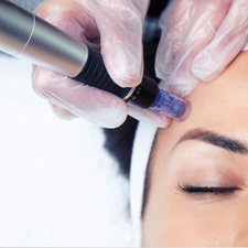 Person receiving a microdermabrasion treatment with a handheld device.