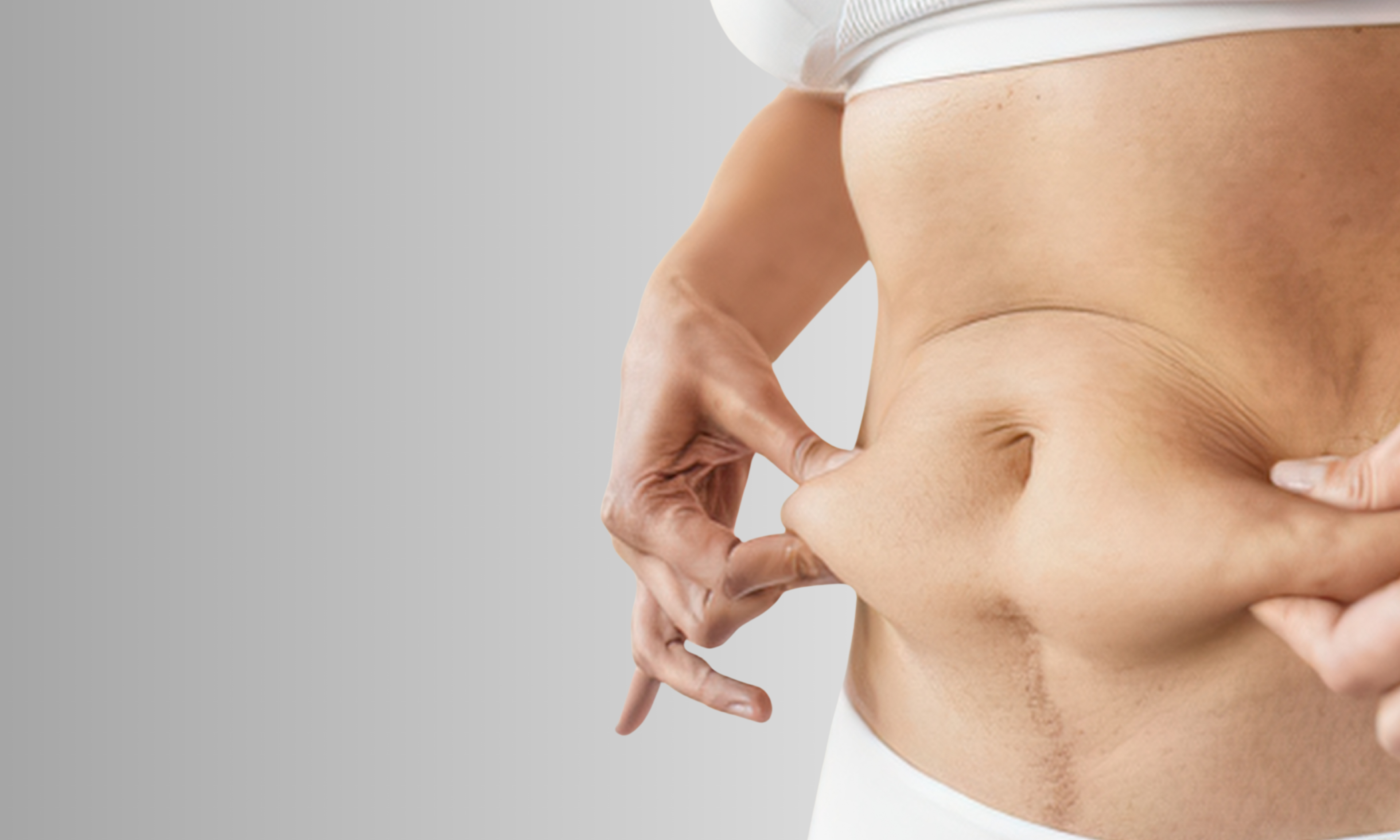 Person pointing to a stretch mark on their stomach against a gray background